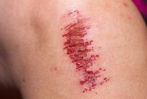 A bad knee scrape such as this one can heal much faster if it's properly cleaned and bandaged. 